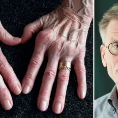 Händer med synliga ådror och knogar, en symbol för kampen mot ledgångsreumatism. Till höger en man med glasögon.