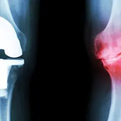 Röntgenbilder av knän: ett med protes, ett med inflammation. Frågan är hur lång tid tar det innan kortison verkar för att lindra smärtan.