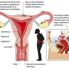 Illustration av livmodern och äggledare. Visar hur livmoderslemhinnan kan orsaka inflammation livmoder och endometrios.