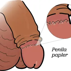 Illustration av en penis med en förstorad bild som visar prickar på ollonet, kallade penila papler.