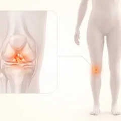 Illustration av ett knä med en skadad korsband, som visar vikten av korsbandsskada rehab för återhämtning.