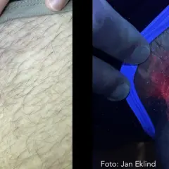 Hudutslag i ljumsken, synligt rött och fjällande. Under UV-ljus lyser utslaget starkt rött, vilket kan vara relaterat till klåda pungen diabetes.