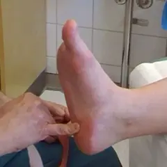 Här tejpas plantar fasciit med kinesiotejp för smärtlindring.