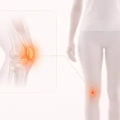 Illustration av ett knä med en inflammerad bursit. En linje pekar från det inflammerade området på knät till en person som håller handen över sitt knä.
