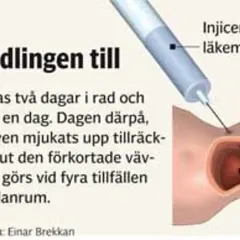 Illustration visar injektion av läkemedel för att behandla Peyronies sjukdom, mjukar upp hård bindväv.