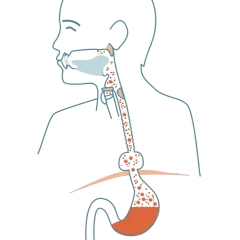Illustration av matstrupen och magsäcken som visar reflux och potentiell risk för bråck på magmunnen cancer.