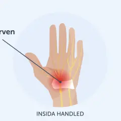 Illustration visar hur medianusnerven kläms i handleden, vilket kan orsaka karpaltunnelsyndrom och ont i tummen.