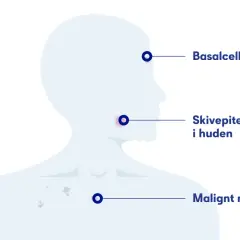 Illustration visar olika hudcancerformer: basalcellscancer, skivepitelcancer i huden och malignt melanom.