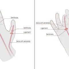 Illustration av senor, ligament och senknutor i handen. Kan visa var en kramp i fingrar kan uppstå.