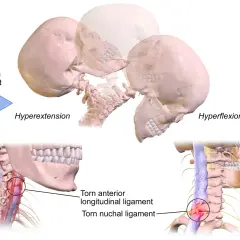Illustration visar hur en bruten nacke symtom kan uppstå vid hyperextension och hyperflexion, med skadade ligament i nacken.