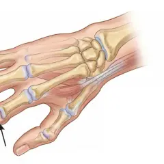 Illustration av handens skelett med reumatiska noduli vid lederna. Pilarna visar rörelsebegränsning.