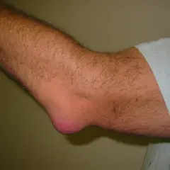 En arm med tydlig svullnad vid armbågen, troligen bursit armbåge.