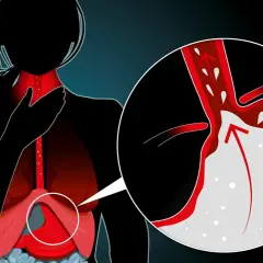 Illustration visar en person med halsbränna. En närbild visar magsyra som stiger upp i matstrupen, en möjlig indikation på att sluta med omeprazol biverkningar.