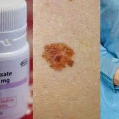 Metotrexat-flaska, hudförändring och person med magsmärtor. Viktigt att undvika alkohol vid behandling med metotrexat.