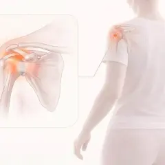 Illustration av en axel med inflammation, som visar en impingement test. Rött markerar smärtområdet.