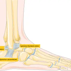 Illustration av fotens ben och ligament. Kan visa ett brutet ben i foten.