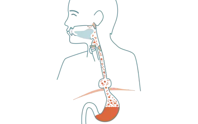 Illustration av matstrupen och magsäcken som visar reflux och potentiell risk för bråck på magmunnen cancer.
