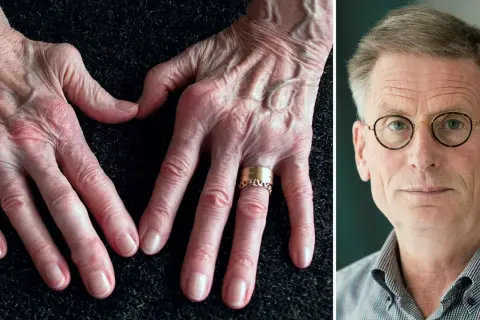 Händer med synliga ådror och knogar, en symbol för kampen mot ledgångsreumatism. Till höger en man med glasögon.