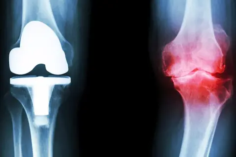 Röntgenbilder av knän: ett med protes, ett med inflammation. Frågan är hur lång tid tar det innan kortison verkar för att lindra smärtan.
