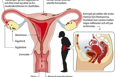 Illustration av livmodern och äggledare. Visar hur livmoderslemhinnan kan orsaka inflammation livmoder och endometrios.