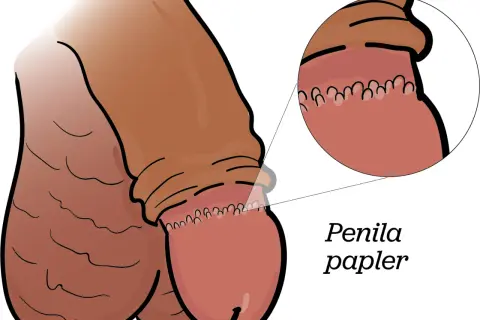 Illustration av en penis med en förstorad bild som visar prickar på ollonet, kallade penila papler.