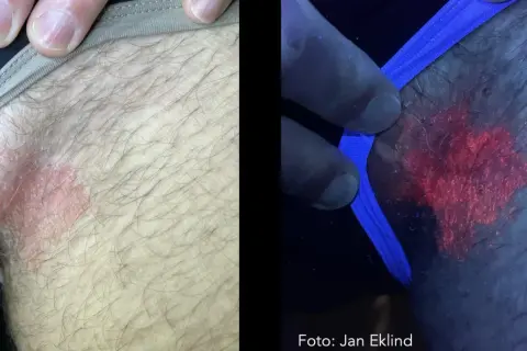 Hudutslag i ljumsken, synligt rött och fjällande. Under UV-ljus lyser utslaget starkt rött, vilket kan vara relaterat till klåda pungen diabetes.