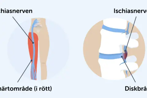 Illustration av ischiasnerven och diskbråck. Smärtområde i rött på benet.