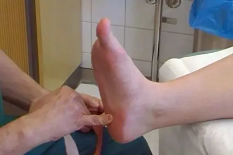 Här tejpas plantar fasciit med kinesiotejp för smärtlindring.