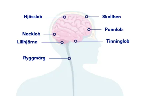 Illustration visar hjärnan och ryggmärgen med markeringar för olika slags huvudvärk: skallben, hjässlob, pannlob, tinninglob, nacklob och lillhjärna.