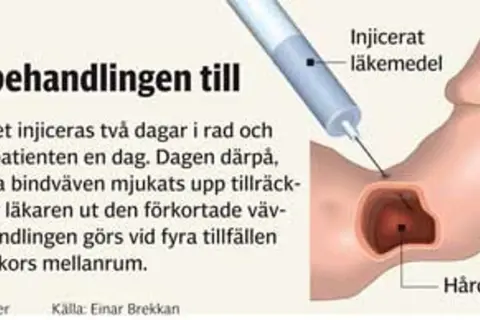 Illustration visar injektion av läkemedel för att behandla Peyronies sjukdom, mjukar upp hård bindväv.