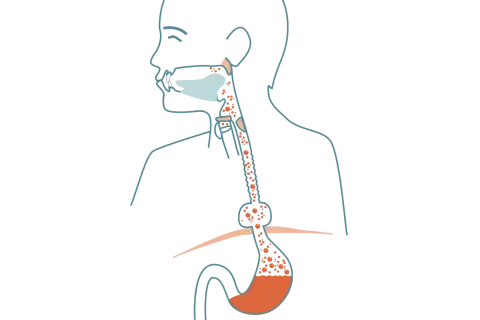 Illustration av matstrupen och magsäcken som visar reflux och potentiell risk för bråck på magmunnen cancer.