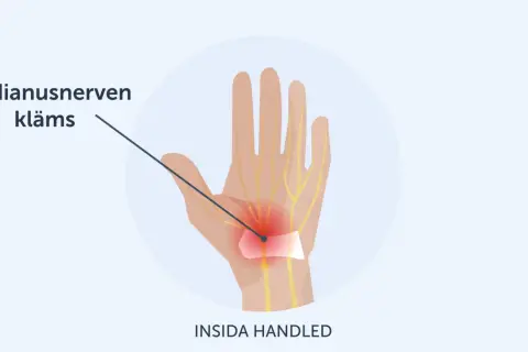 Illustration visar hur medianusnerven kläms i handleden, vilket kan orsaka karpaltunnelsyndrom och ont i tummen.