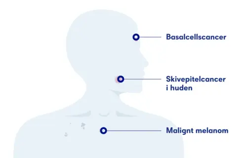 Illustration visar olika hudcancerformer: basalcellscancer, skivepitelcancer i huden och malignt melanom.