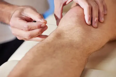 Akupunkturbehandling av nervsmärta i knät. En nål förs in i huden.