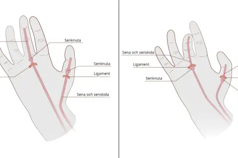 Illustration av senor, ligament och senknutor i handen. Kan visa var en kramp i fingrar kan uppstå.