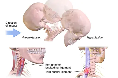 Illustration visar hur en bruten nacke symtom kan uppstå vid hyperextension och hyperflexion, med skadade ligament i nacken.