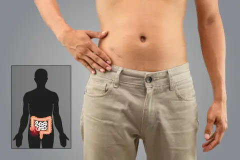 En illustration visar en mänsklig silhuett med tarmar, där ett område markerats med rött för att indikera mesenteriell lymfadenit. En person pekar på sitt eget magparti.