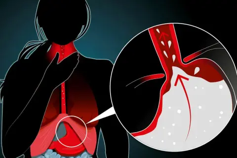 Illustration visar en person med halsbränna. En närbild visar magsyra som stiger upp i matstrupen, en möjlig indikation på att sluta med omeprazol biverkningar.