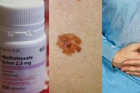 Metotrexat-flaska, hudförändring och person med magsmärtor. Viktigt att undvika alkohol vid behandling med metotrexat.