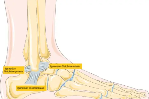 Illustration av fotens ben och ligament. Kan visa ett brutet ben i foten.