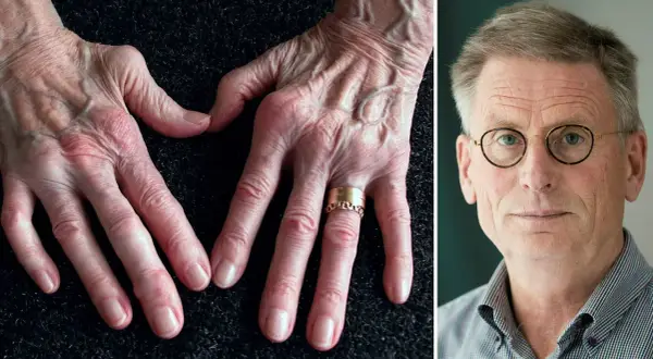 Händer med synliga ådror och knogar, en symbol för kampen mot ledgångsreumatism. Till höger en man med glasögon.