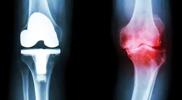 Röntgenbilder av knän: ett med protes, ett med inflammation. Frågan är hur lång tid tar det innan kortison verkar för att lindra smärtan.