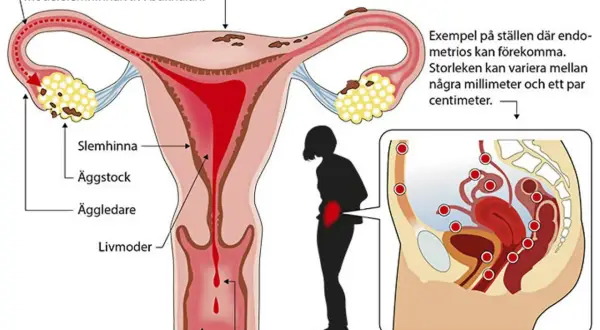 Illustration av livmodern och äggledare. Visar hur livmoderslemhinnan kan orsaka inflammation livmoder och endometrios.