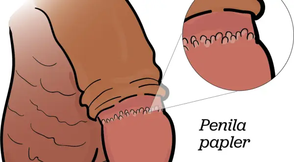 Illustration av en penis med en förstorad bild som visar prickar på ollonet, kallade penila papler.