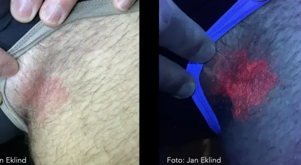 Hudutslag i ljumsken, synligt rött och fjällande. Under UV-ljus lyser utslaget starkt rött, vilket kan vara relaterat till klåda pungen diabetes.