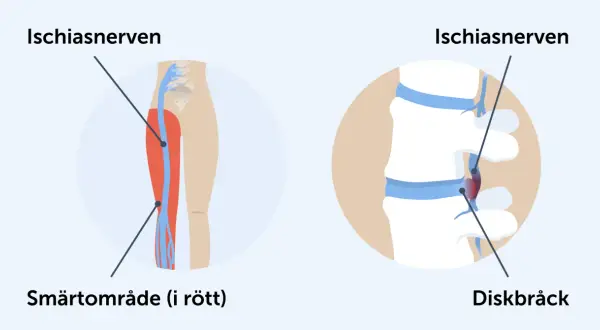 Illustration av ischiasnerven och diskbråck. Smärtområde i rött på benet.