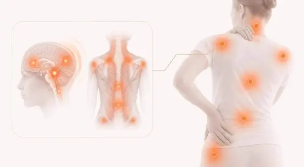 Illustration visar hur smärta kan uppstå i hjärnan och kroppen, vilket kan förklara varför man får myalgi.