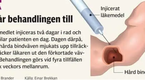 Illustration visar injektion av läkemedel för att behandla Peyronies sjukdom, mjukar upp hård bindväv.