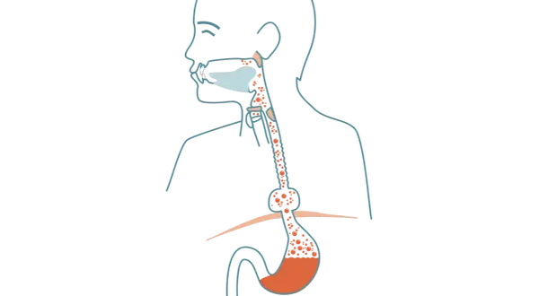 Illustration av matstrupen och magsäcken som visar reflux och potentiell risk för bråck på magmunnen cancer.