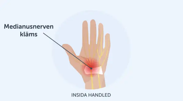 Illustration visar hur medianusnerven kläms i handleden, vilket kan orsaka karpaltunnelsyndrom och ont i tummen.